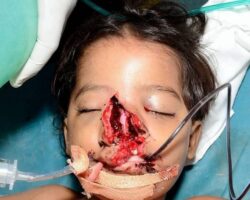 Doctors removed a fence from face of 7-year-old boy