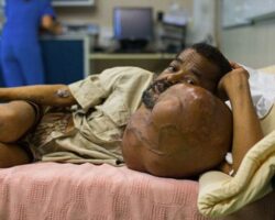 Dude lived with a giant tumor for over 40 years
