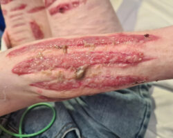 Infected wounds of 17-year-old teenage girl