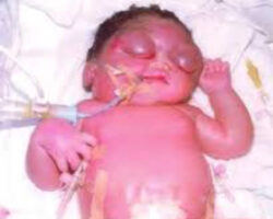 MIX: Dead newborns of hydrops fetalis