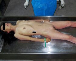 Autopsy of young Chinese woman