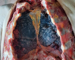Autopsy photo of smoker lungs