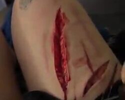 Drunk teen girl cuts herself in thigh
