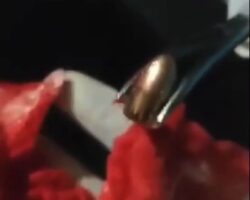 Extracting bullet from woman’s shoulder