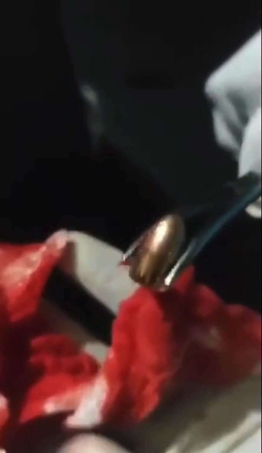 Extracting bullet from woman’s shoulder • GoreCenter