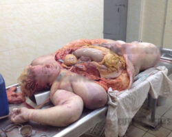Autopsy of obese woman