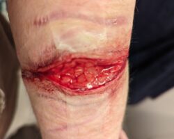 Razor blade self-harm wound