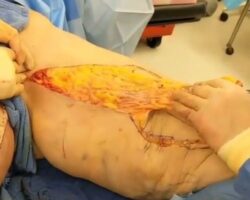 Surgical removal of excess skin on thigh