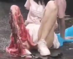 Young Asian woman has torn leg after accident