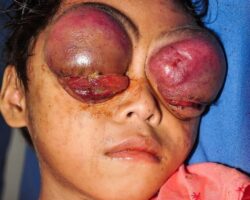 6-year-old girl’s eyes bulged out of her head due to cancer