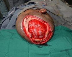 Auto-transplantation of skin on head