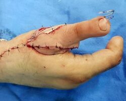Auto-transplantation of toe to hand