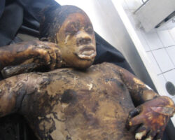 Autopsy of burnt pregnant woman