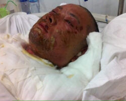 Burned man in hospital