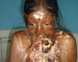 Disfigured woman due to skin disease