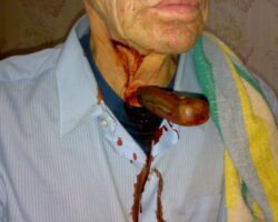 Elderly man with knife stuck in his throat