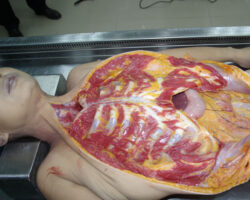 Examination and autopsy of Chinese woman found dead in bed