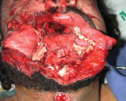 Facial plastic surgery on US soldier in Afghan field hospital