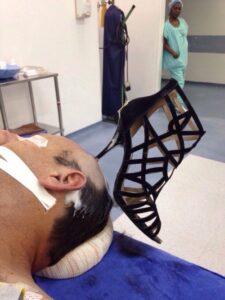 High heel impaled in head
