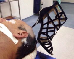 High heel impaled in head