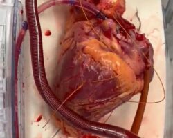 Human heart ready for transplantation