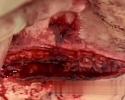 Large cut on dead woman’s abdomen