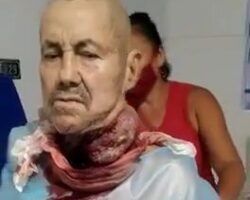 Man with huge tumor on his neck