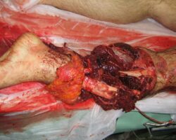 Open leg fracture