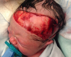 Partially scalped newborn during cesarean delivery