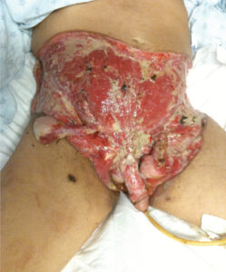 Extreme gangrene