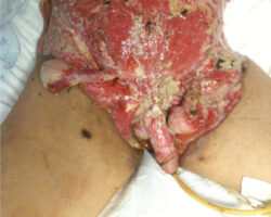 Patient with gangrene after surgery