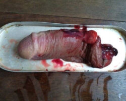 Man with severed dick