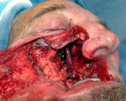 Surgical face reconstruction
