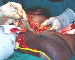 Surgical removal of giant tumour