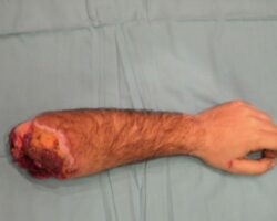 Surgical rescue of amputated arm