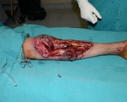 Surgical rescue of injured leg by skin grafting