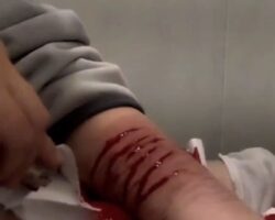 Teenager cuts her arm with razor blade