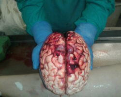 Brain extraction from female cadaver