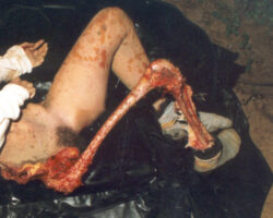 Dead girl eaten by animals