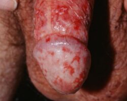 STD infected penis