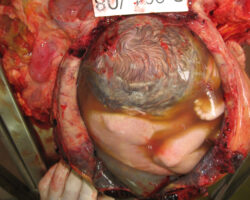 Autopsy of pregnant woman
