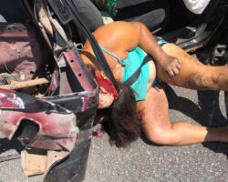 Woman scalped by seat belt