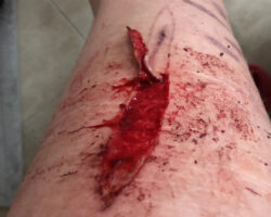 Self-harm