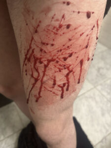 Teen boy self-harm