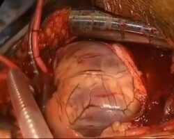 Surgical removal of blood clots from heart
