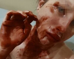 Self-harm