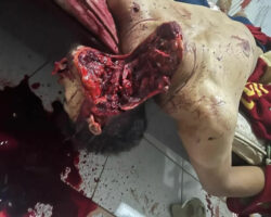 Almost decapitated with machete