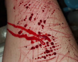 Self-harm