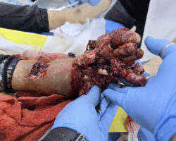 Foot crushed in meat grinder