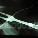 Stabbed to death with BBQ fork